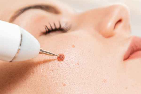CryoPen: 5 Skin Concerns It May Be Used to Treat 3 What actually happens during a CryoPen treatment Witney?