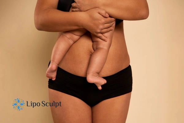 Non-Surgical Options for Diastasis Recti: What You Need to Know About Tone Sculpt 1 Why Consider Non-Surgical Treatment?