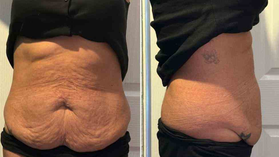 Lost the Weight but Not the Loose Skin? What You Should Know 1 Is It Definitely Loose Skin Witney?
