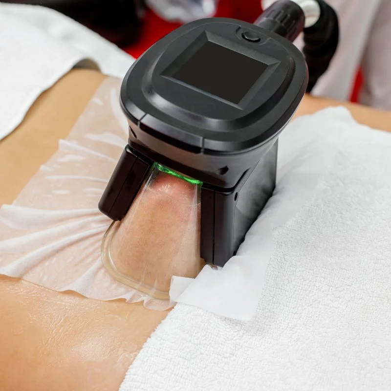 Fat Freezing treatment Witney